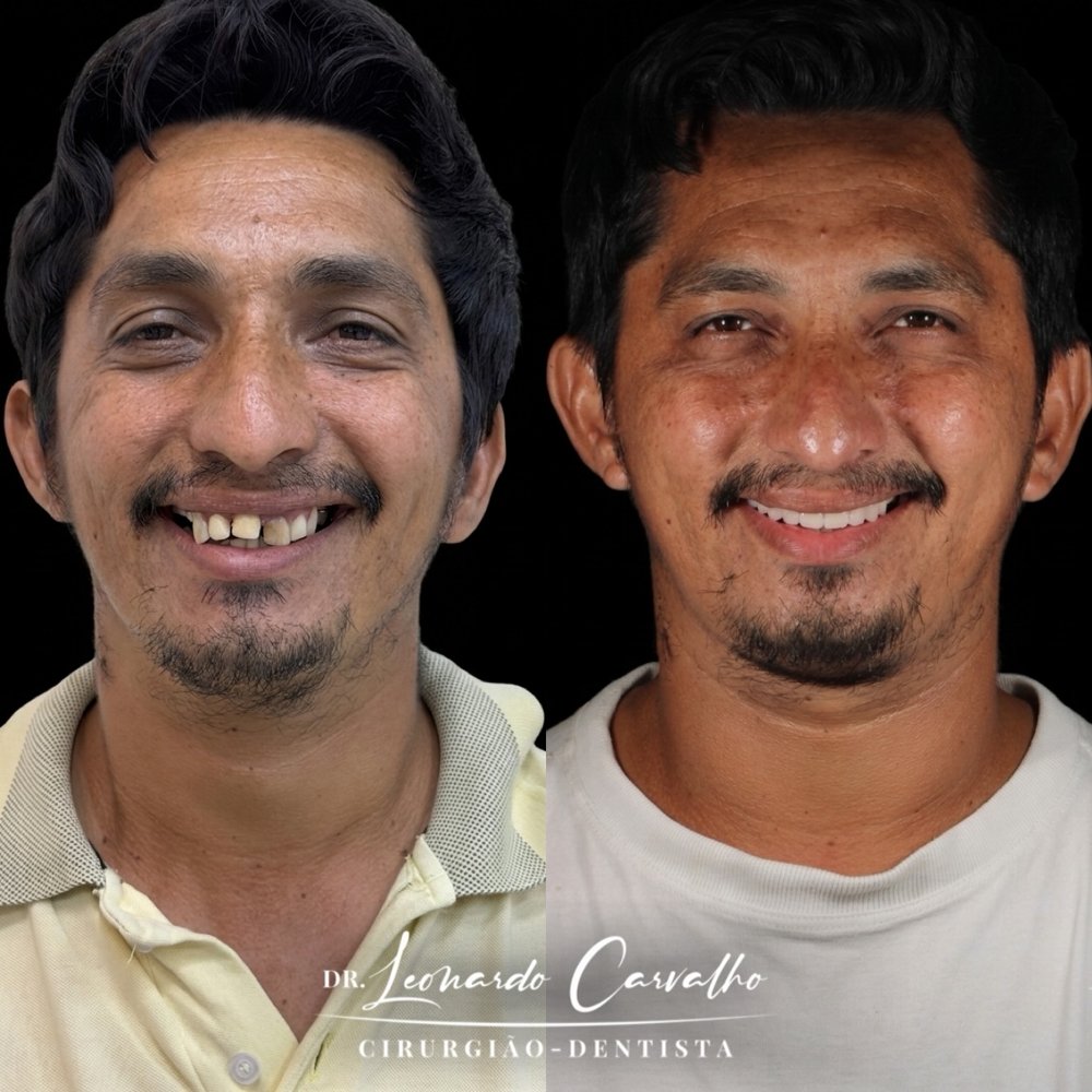 Caso real de reabilitação com prótese protocolo sobre implantes: comparação do sorriso do paciente antes e depois do tratamento